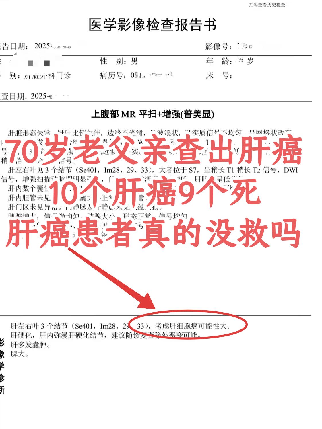 “父亲今年才70，平时就是喜欢喝酒，也不抽烟，咋就肝癌了？都说10个肝...