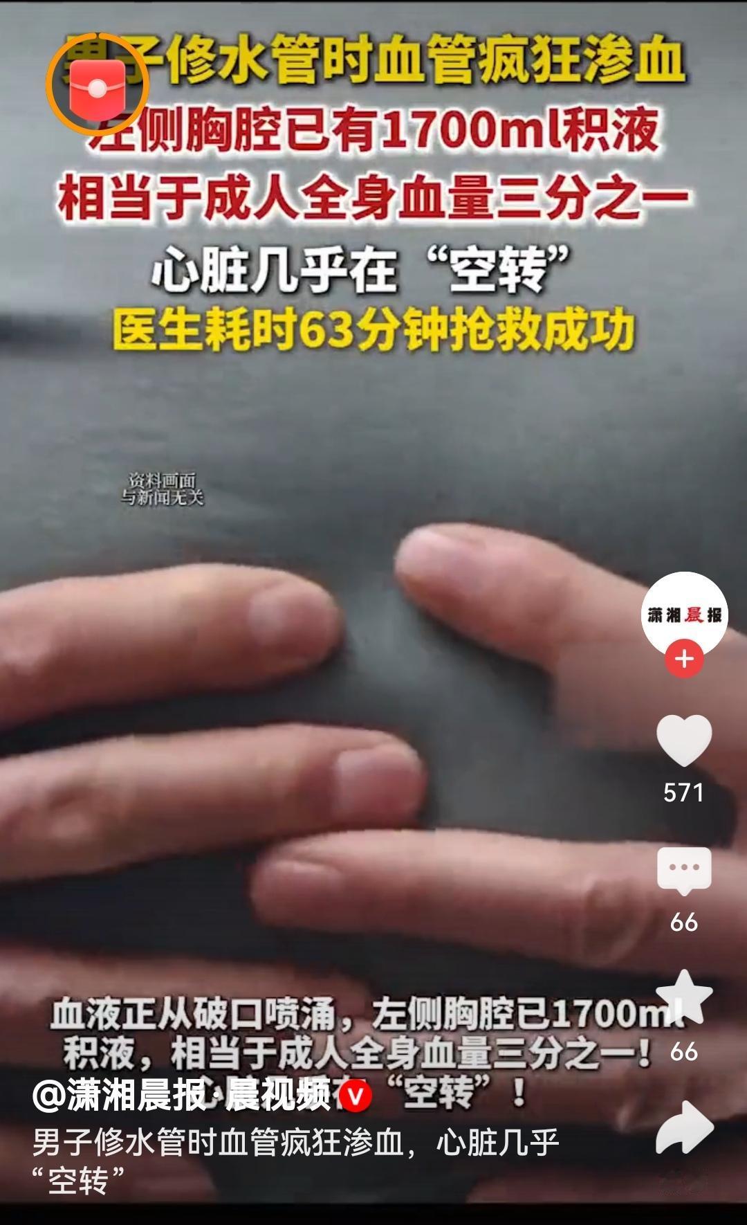 男子修水管时血管疯狂渗血为医护人员的精湛医术点赞！63分钟的生死营救，从死神手中