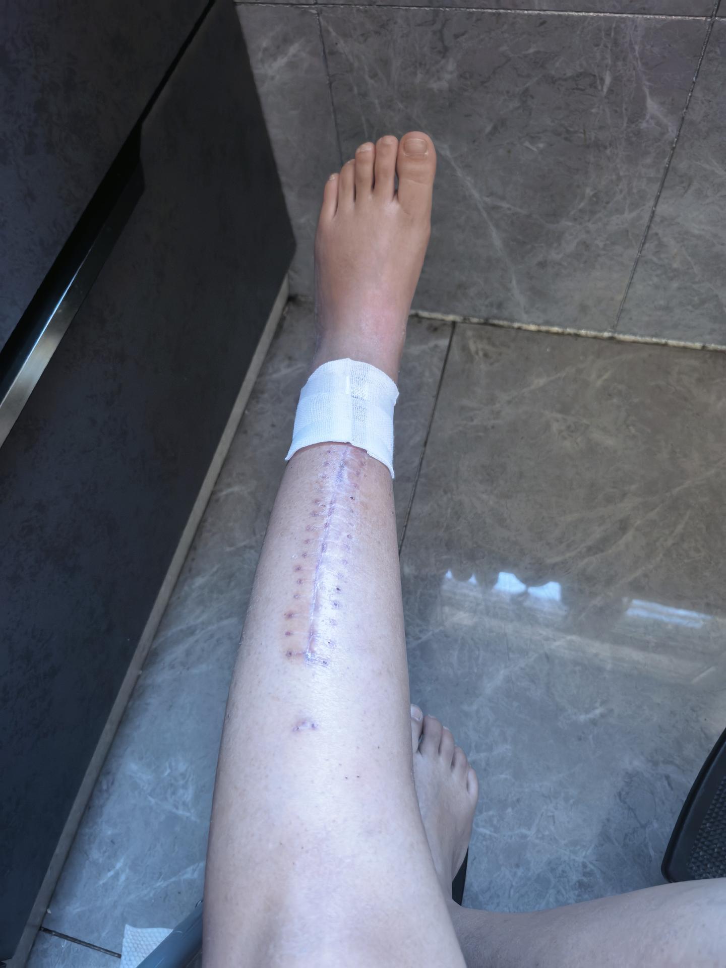 手欠扣了个血痂，结果血痂挺深连着肉。立马慌成狗。又给捂上了。根本忍不住😞