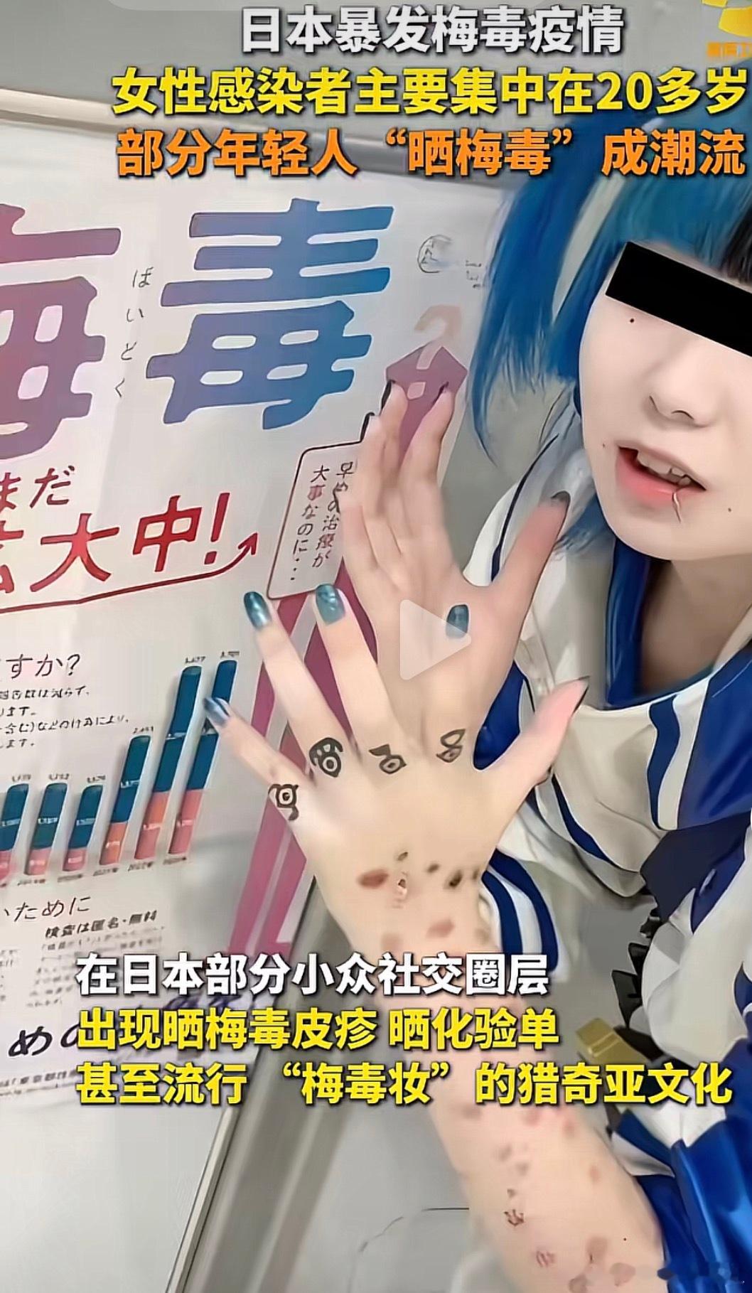 日本爆发梅毒疫情 这个肮脏的国家，梅毒这种病本身是出现在动物身上的，只从西方与动