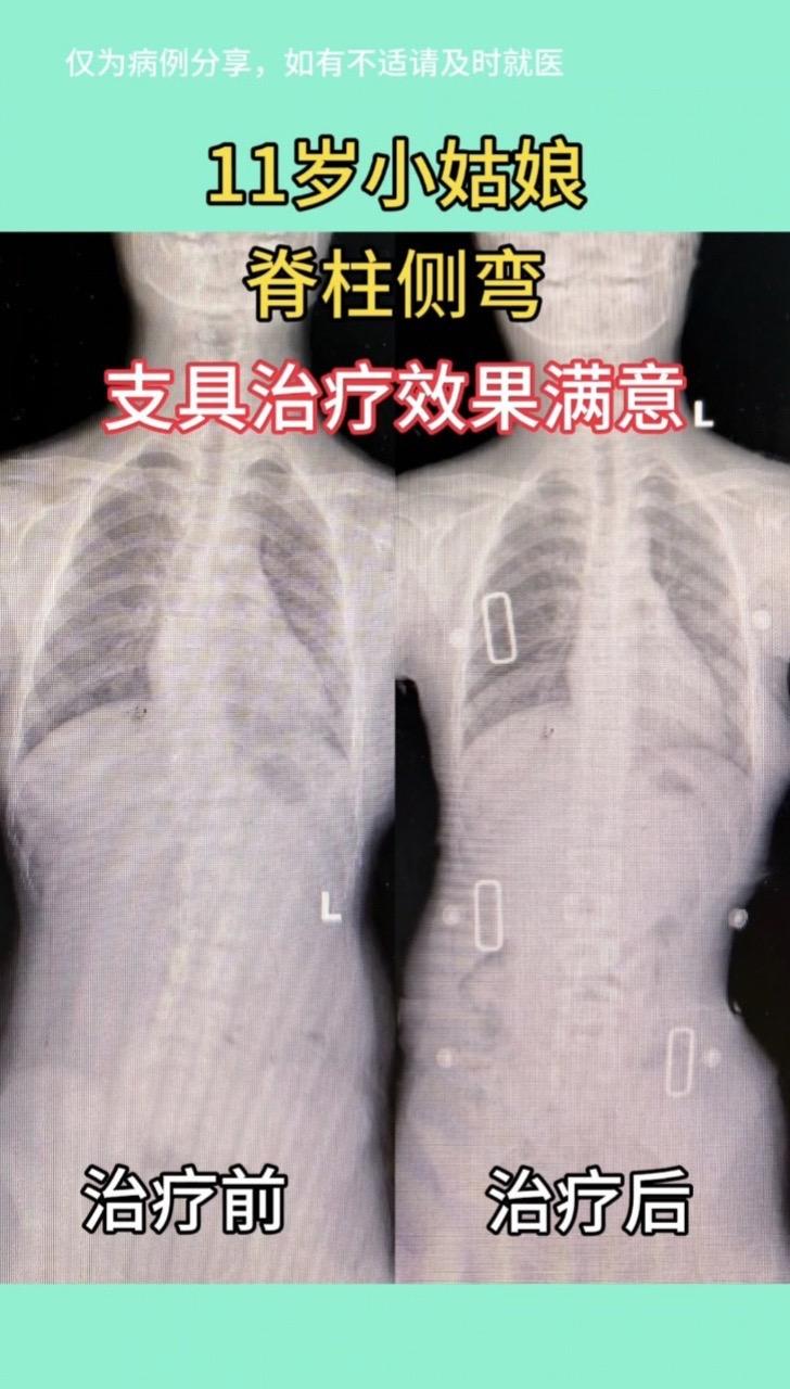 11小姑娘 脊柱侧弯 支具治疗效果满意👍