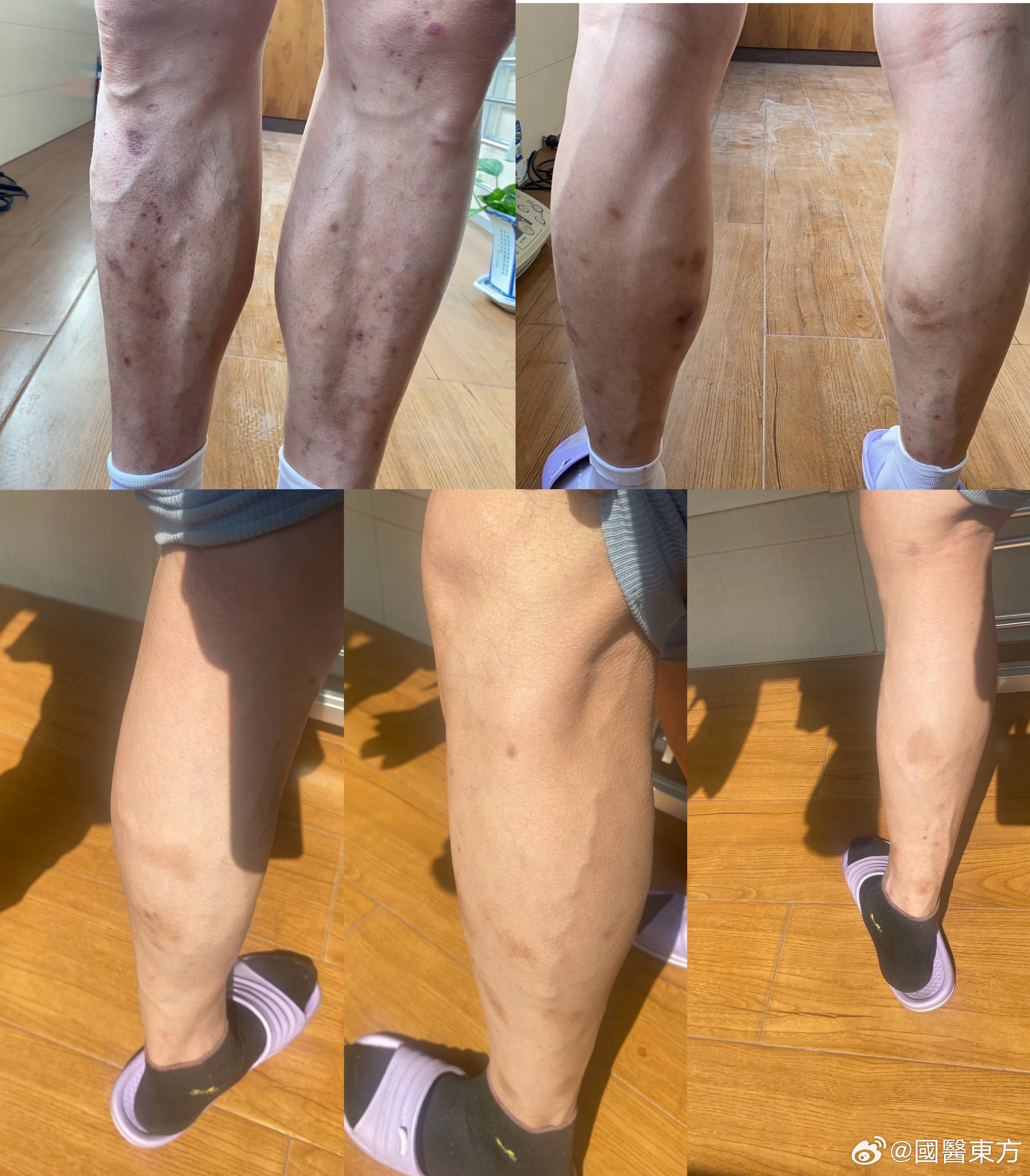 常有女性朋友问我：吃中药能不能淡斑？答案是肯定的。但我作为一名内科大夫，一般不会