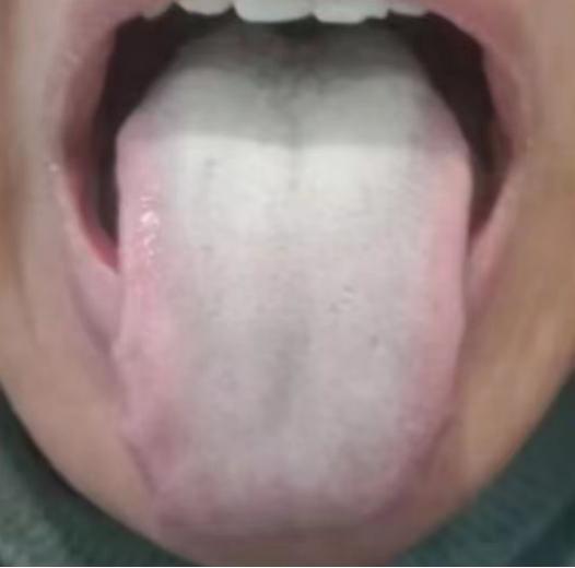 出现这种舌象，越拖问题越多，调理难度也就越大
看这个患者，他就是由痰湿，进而拖成