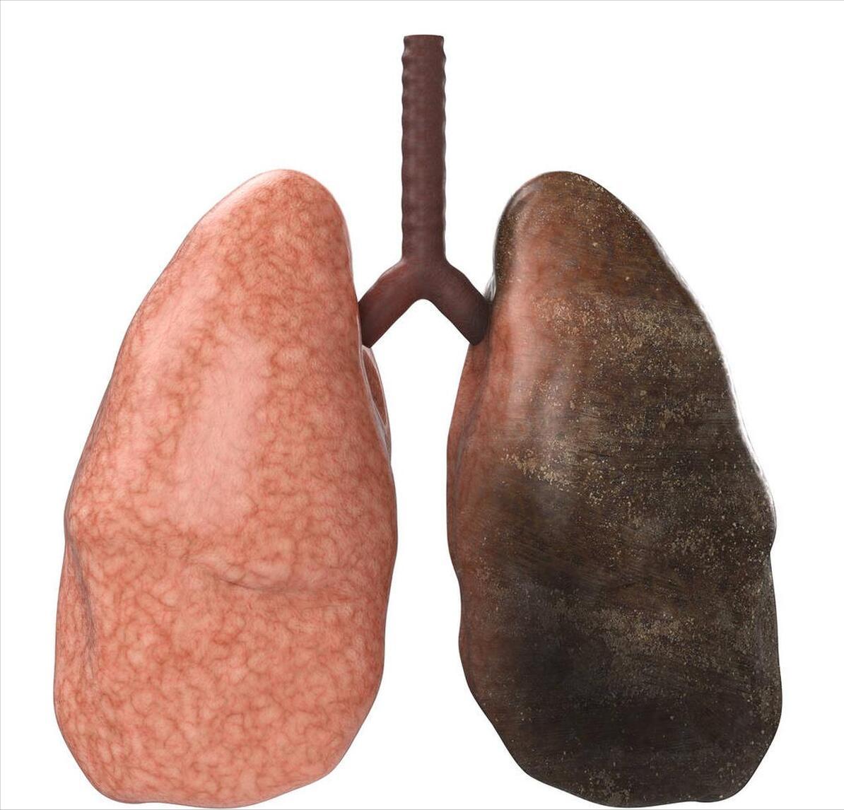 吸烟改变肺，每次看Ct我都能准确判断出来患者有没有吸烟
吸烟伤肺很多人不以为然，