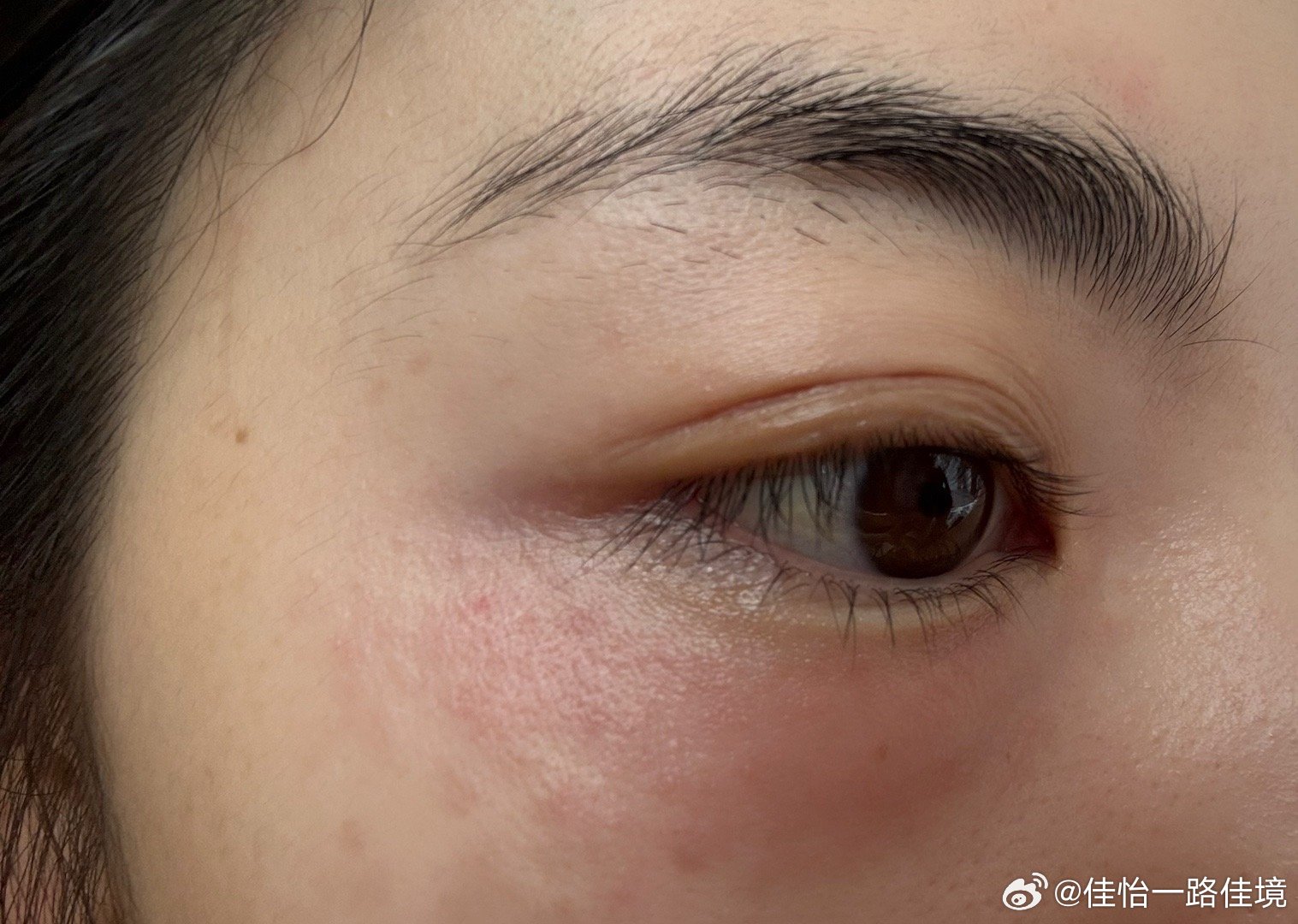 一觉起来两只眼睛肿的睁不开了[苦涩][苦涩][苦涩][苦涩][苦涩] ​​​