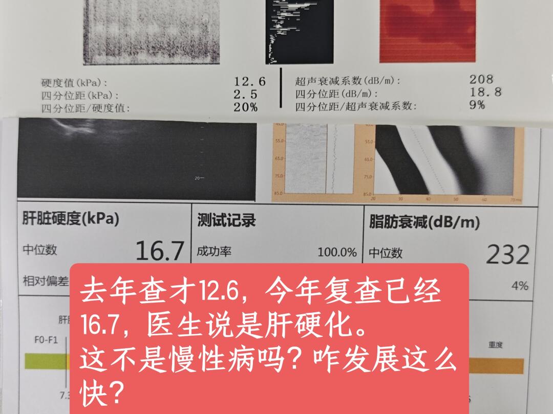 肝硬化发展都这么快吗？