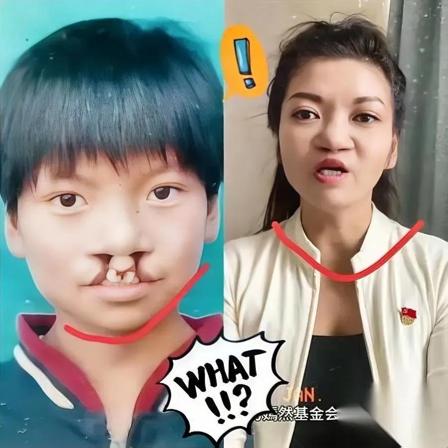 为啥7000个免费治唇腭裂的人，很少帮李亚鹏说话？

不是不想，是揭开伤口比疼更