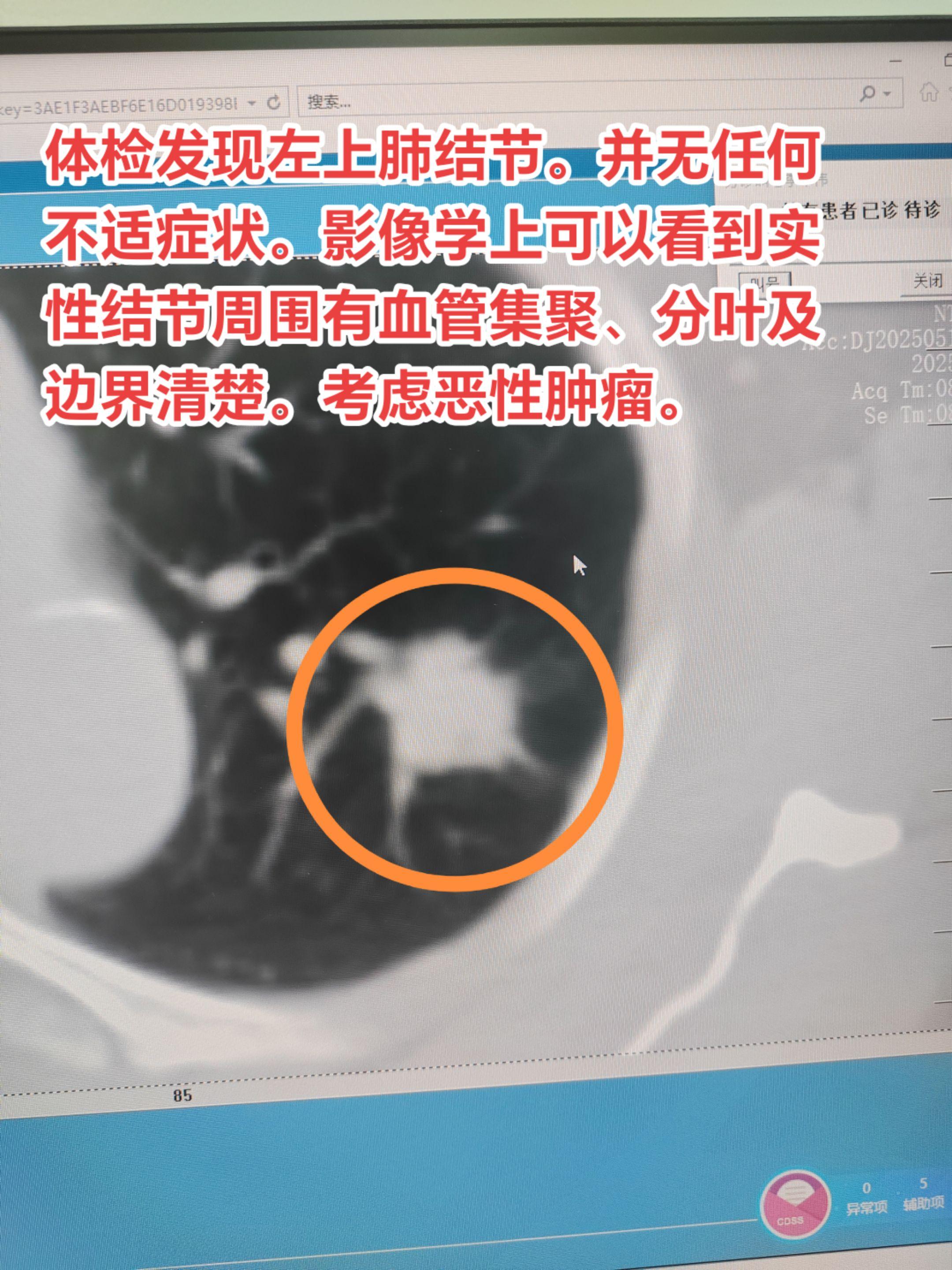 周围型肺癌常无症状，早期多为体检发现。体检发现左上肺结节。并无任何不适...