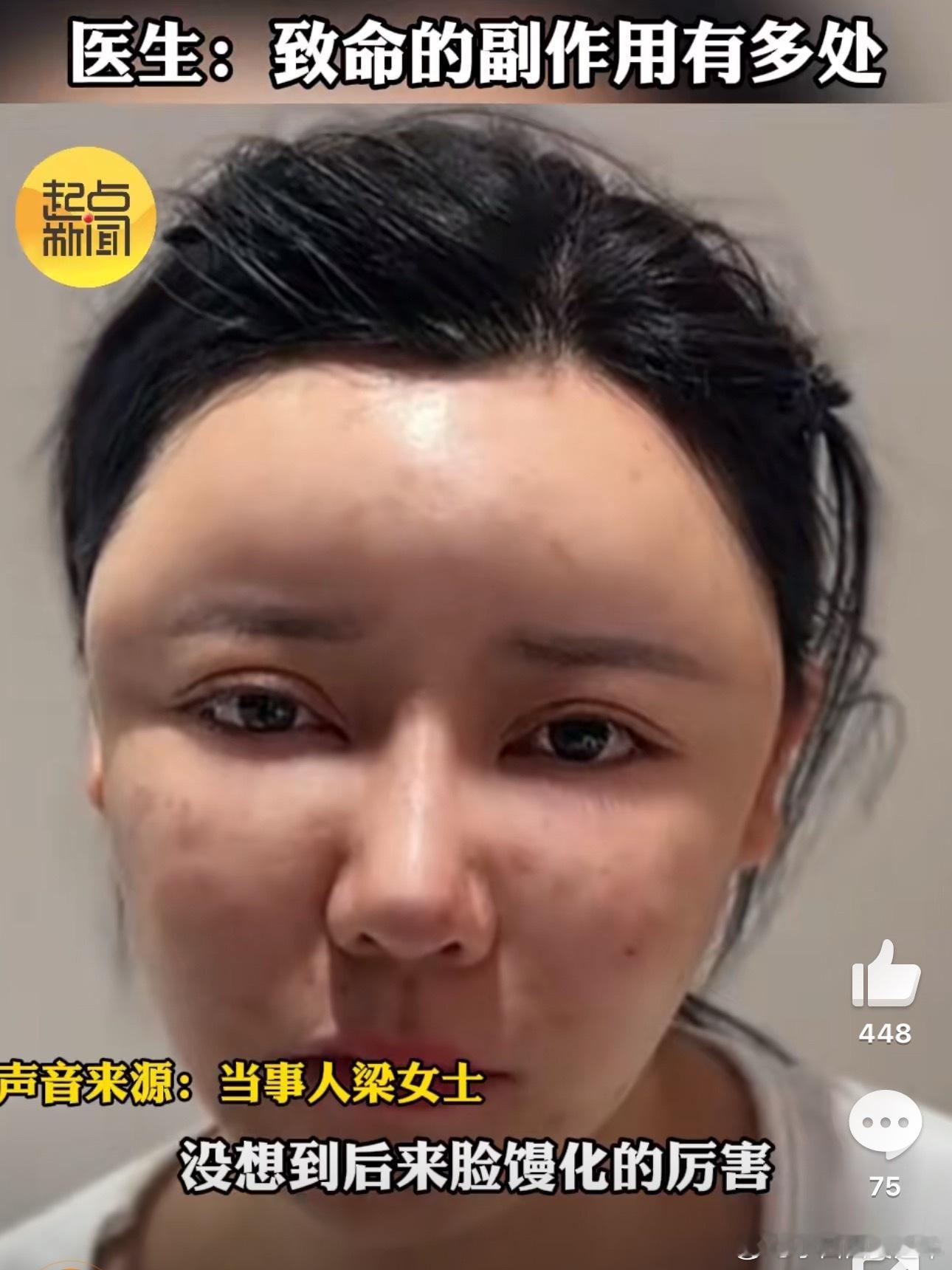 女子过度医美面部馒化酷似面具人不仅馒化，更可怕的是有生命危险……⚠️原先的瓜子脸