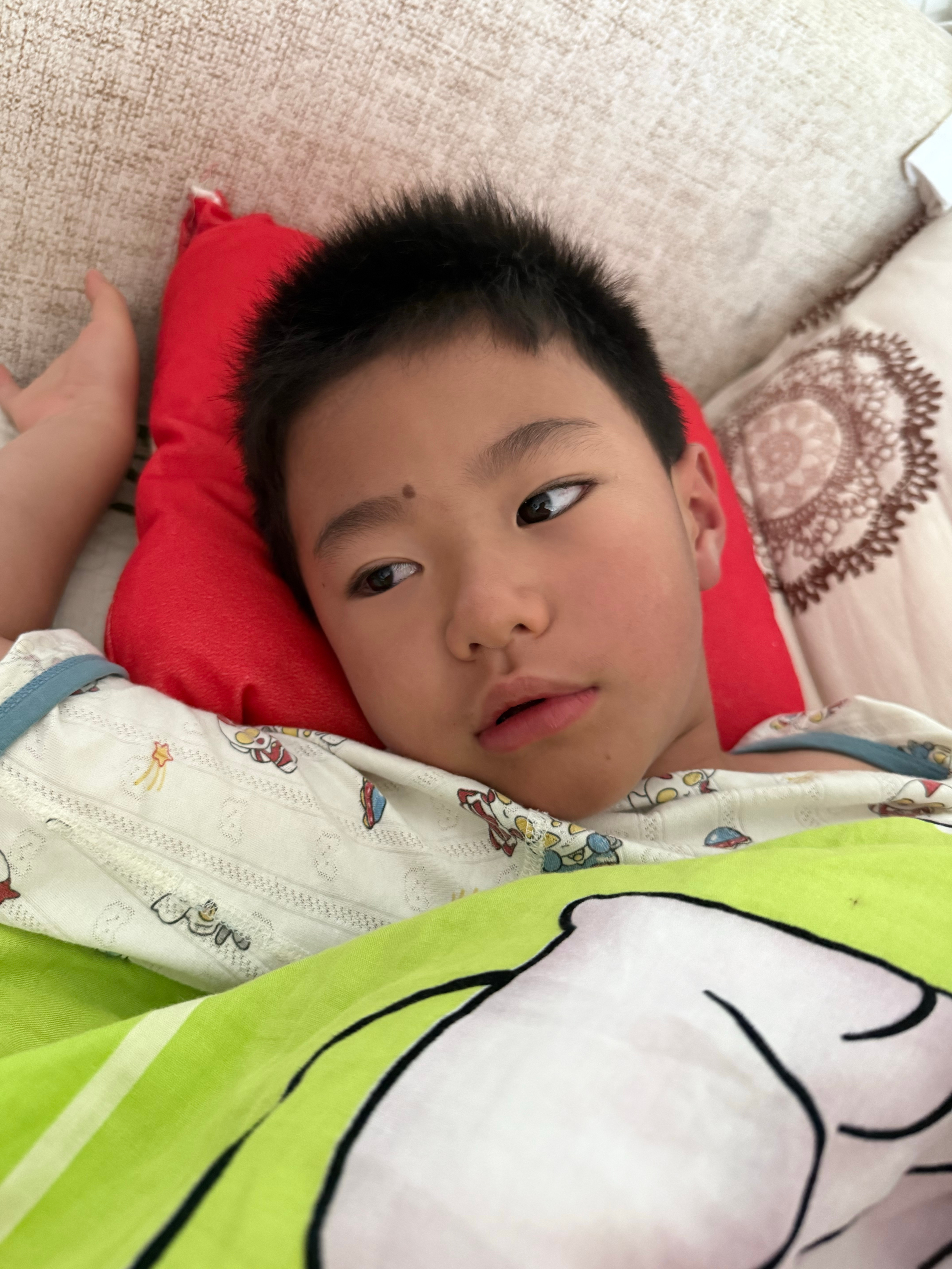烧成双眼皮了(一直是内双)双眼皮要一直都这样了明显就好了哈哈哈 