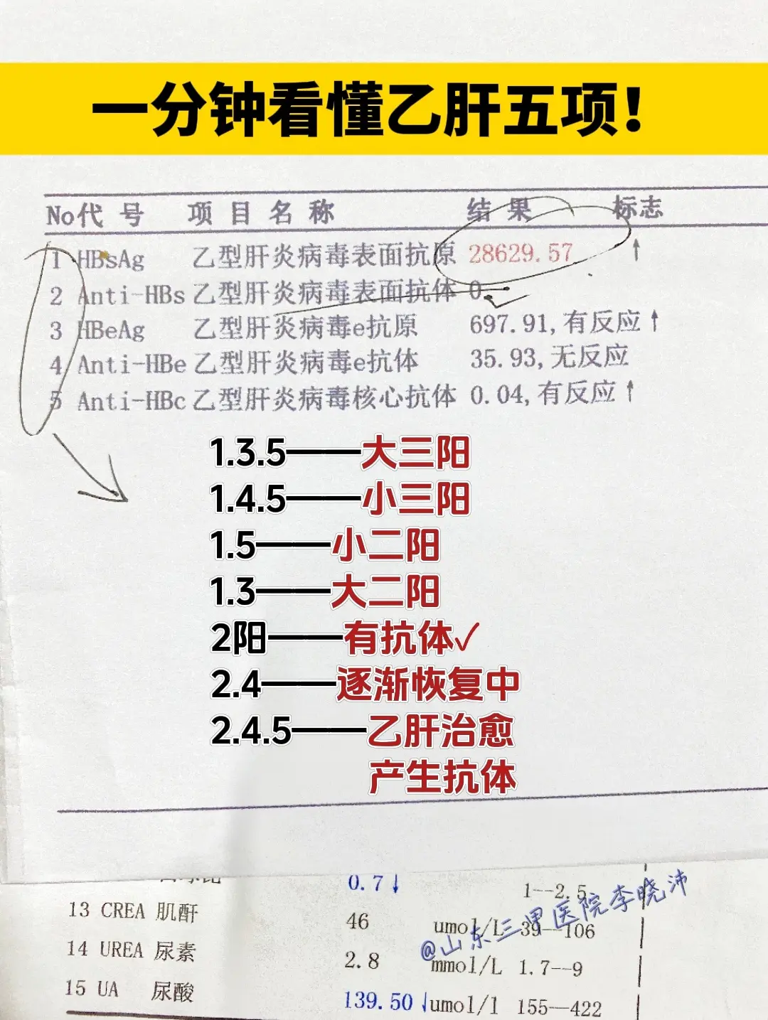 乙肝五项化验单！1、乙肝五项第1项阳性，其余四项阴性，说明是急性病毒感...