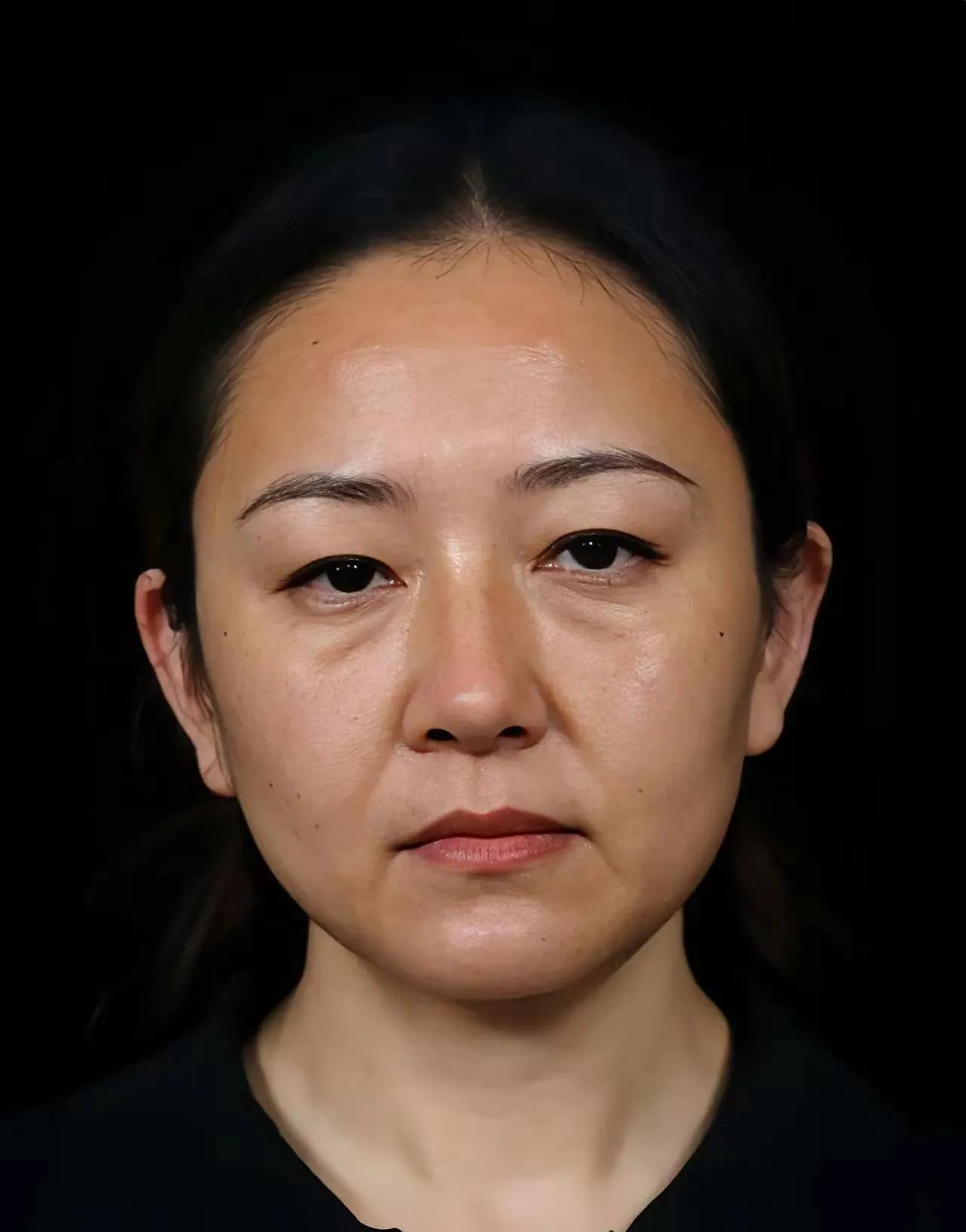 这个脸部提升做的非常成功
最起码足足年轻了二十岁都有吧