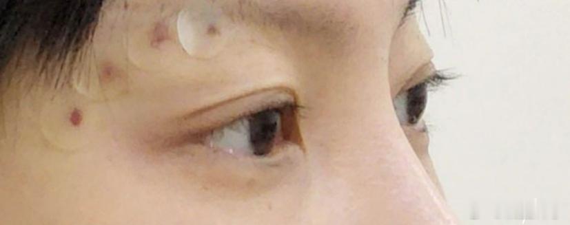 不用额头拉皮，只靠埋线也可以改善眼尾下垂和上眼睑松弛，当然如果你就是想要眼尾上扬