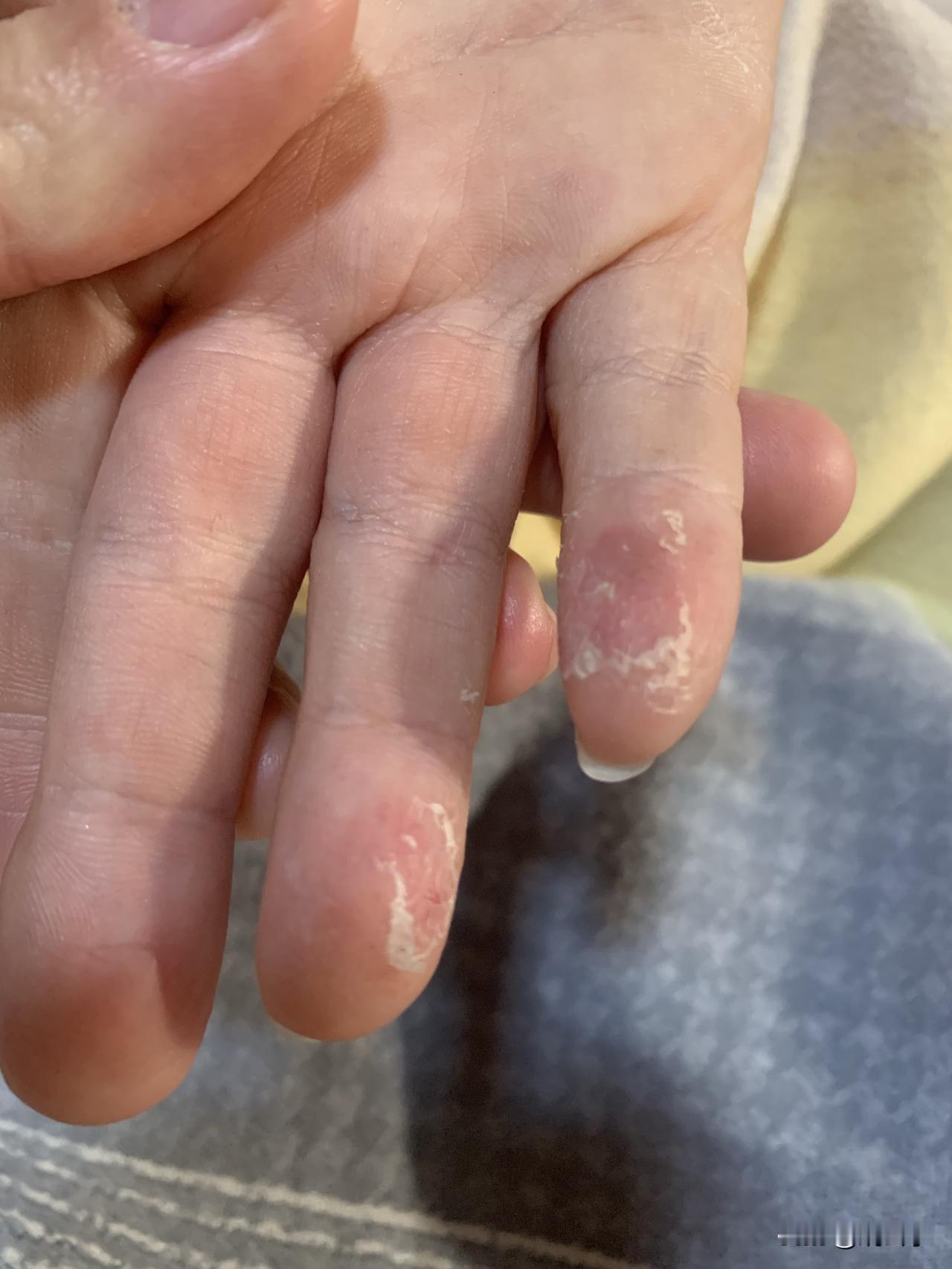 第一次看到娃娃在冬季长了汗疱疹，往年都是夏天长。因为手爱出汗，每年都要长一次，长