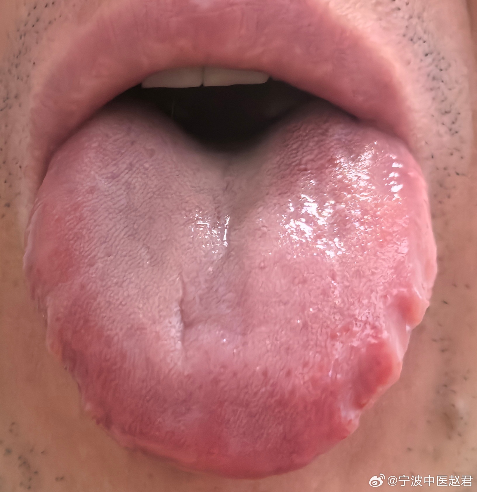失眠病例，病史五年，西医予曲唑酮，中医连用柴龙牡7周无效。从舌象可以看出，上中下