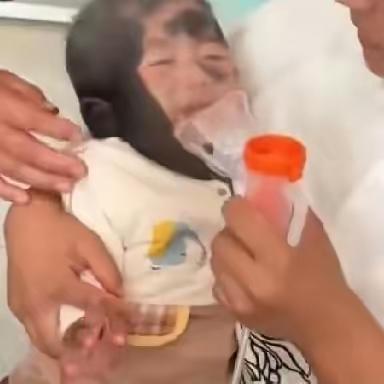 宝宝产检一切正常，出生后却满身兽皮痣，妈妈:“几乎没有好皮”
​​妈妈抱着襁褓里