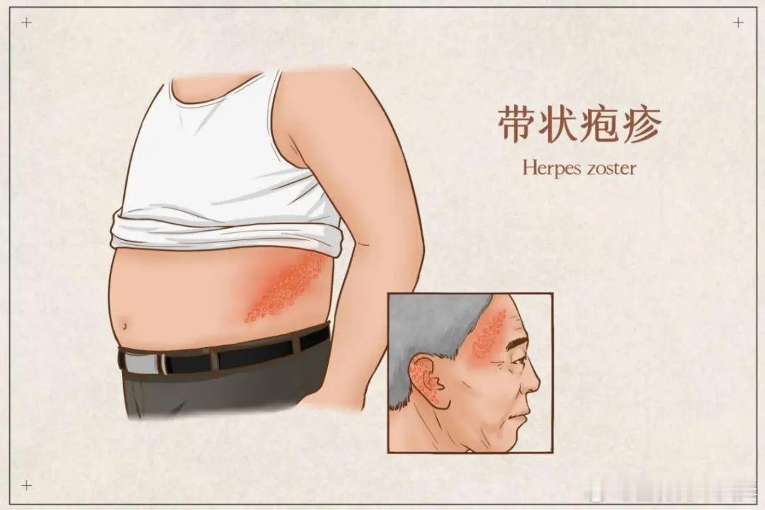 高血压人群更需警惕带状疱疹风险带状疱疹不止是别人的经历  如何有效预防带状疱疹？