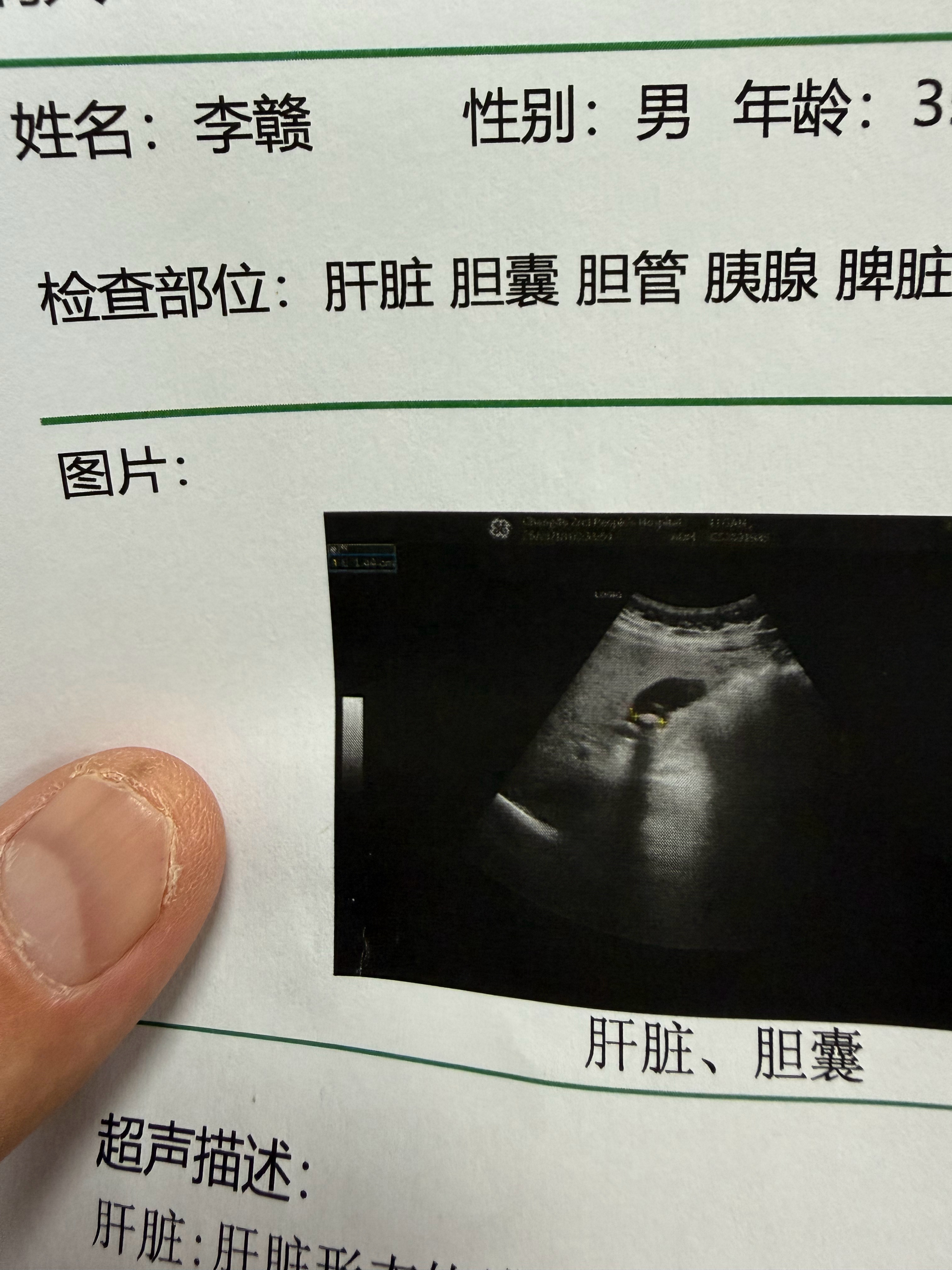 我这个胆结石是不是要做手术了？？？最近吃完饭，胆位置就感觉胀胀的，临床要把胆给割