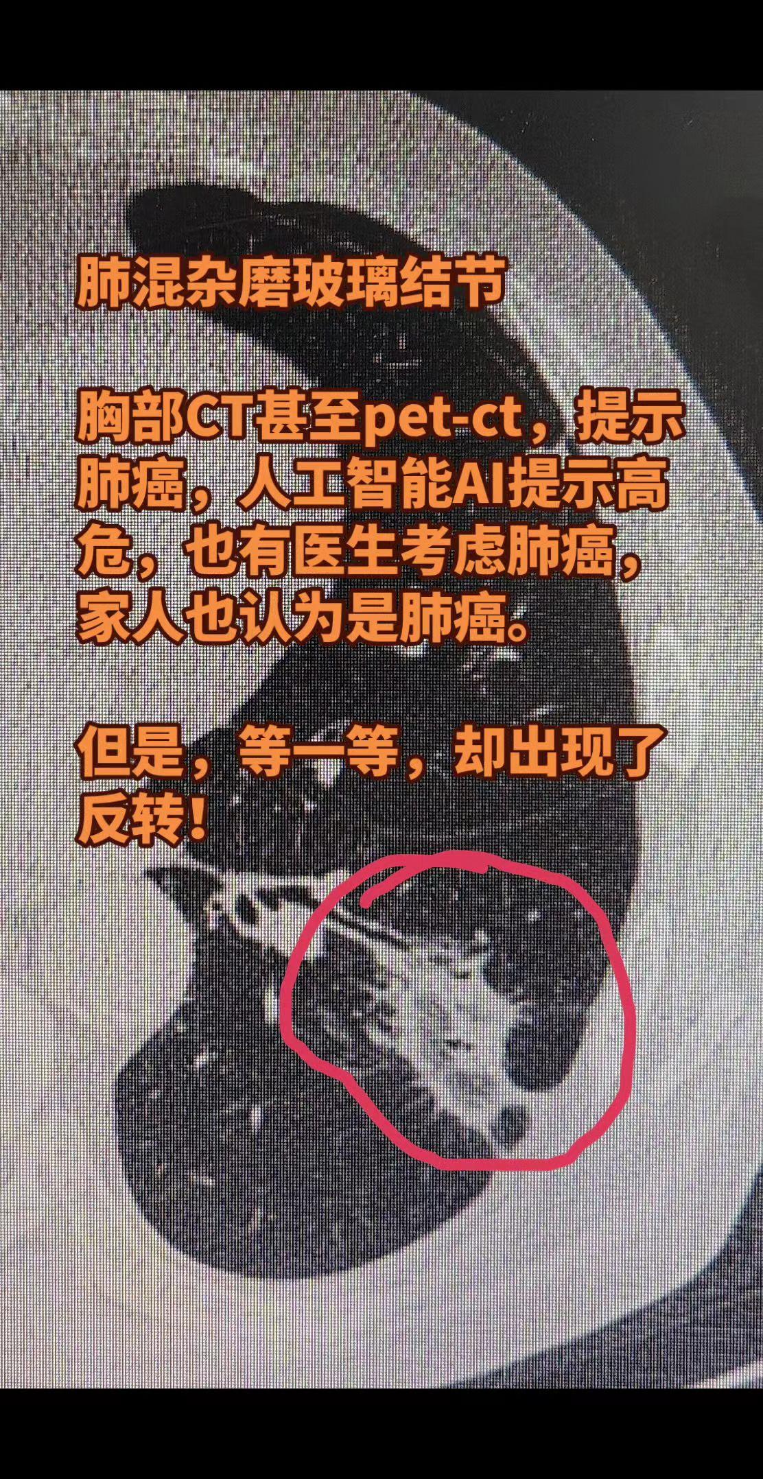 肺混杂磨玻璃结节不一定是肺癌。一老年男性，咳嗽咳痰，检查发现发现左下肺...