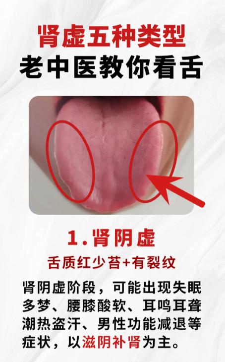 肾虚分 5 种！老中医教你怎么看舌象辨类型