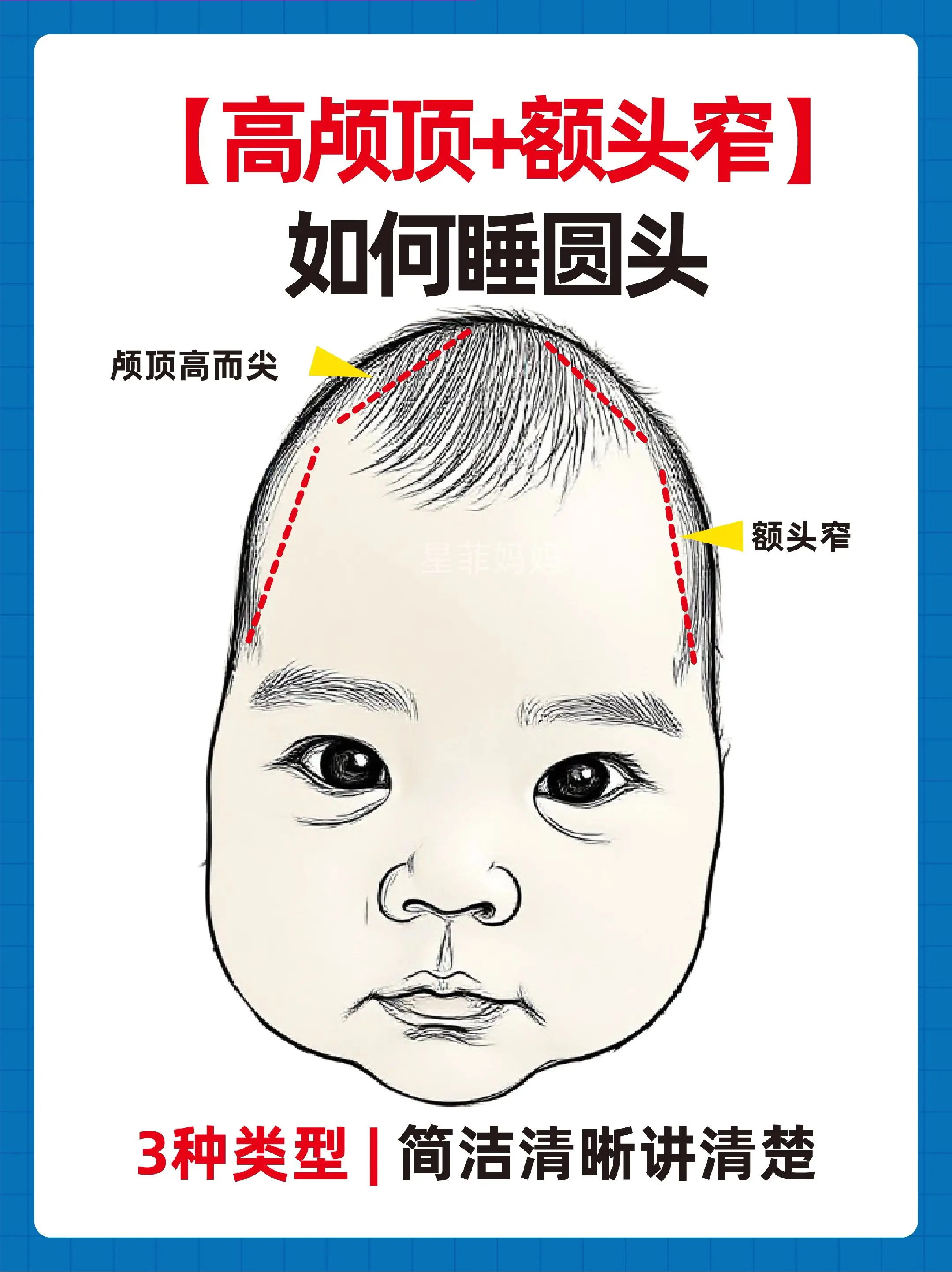 高颅顶+额头窄如何睡圆头。
