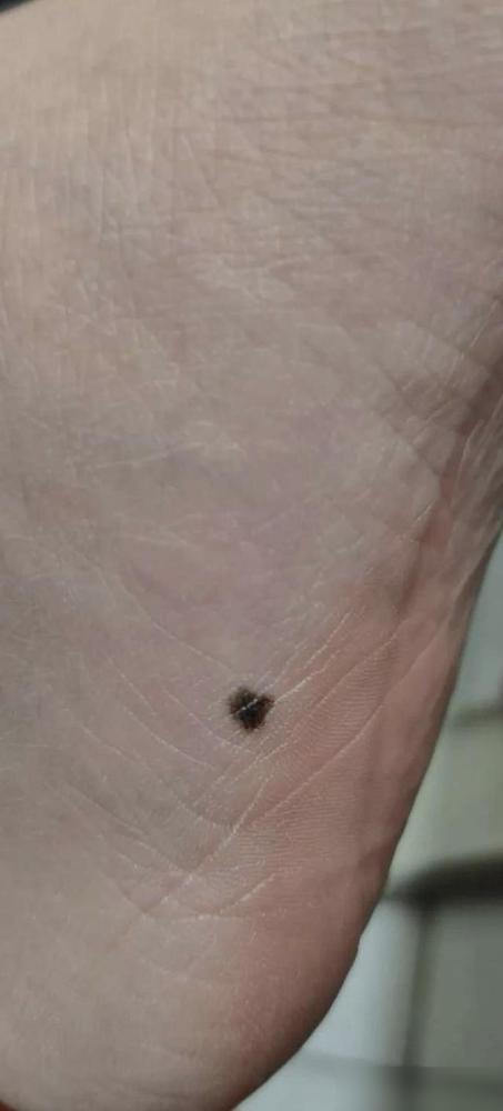 因为脚底一个痣，生命永远定格在了38岁。

看到这事儿心里堵得慌，我干皮肤科相关