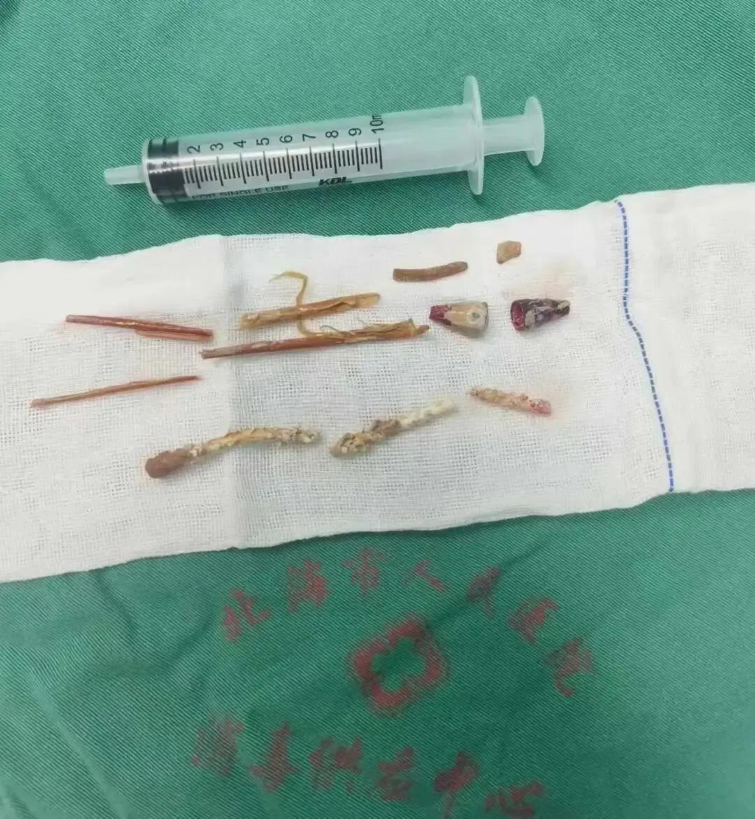 万万没想到！近日，广西北海市人民医院收治一名中年男性患者，其因肾结石合并肾脏脓肿