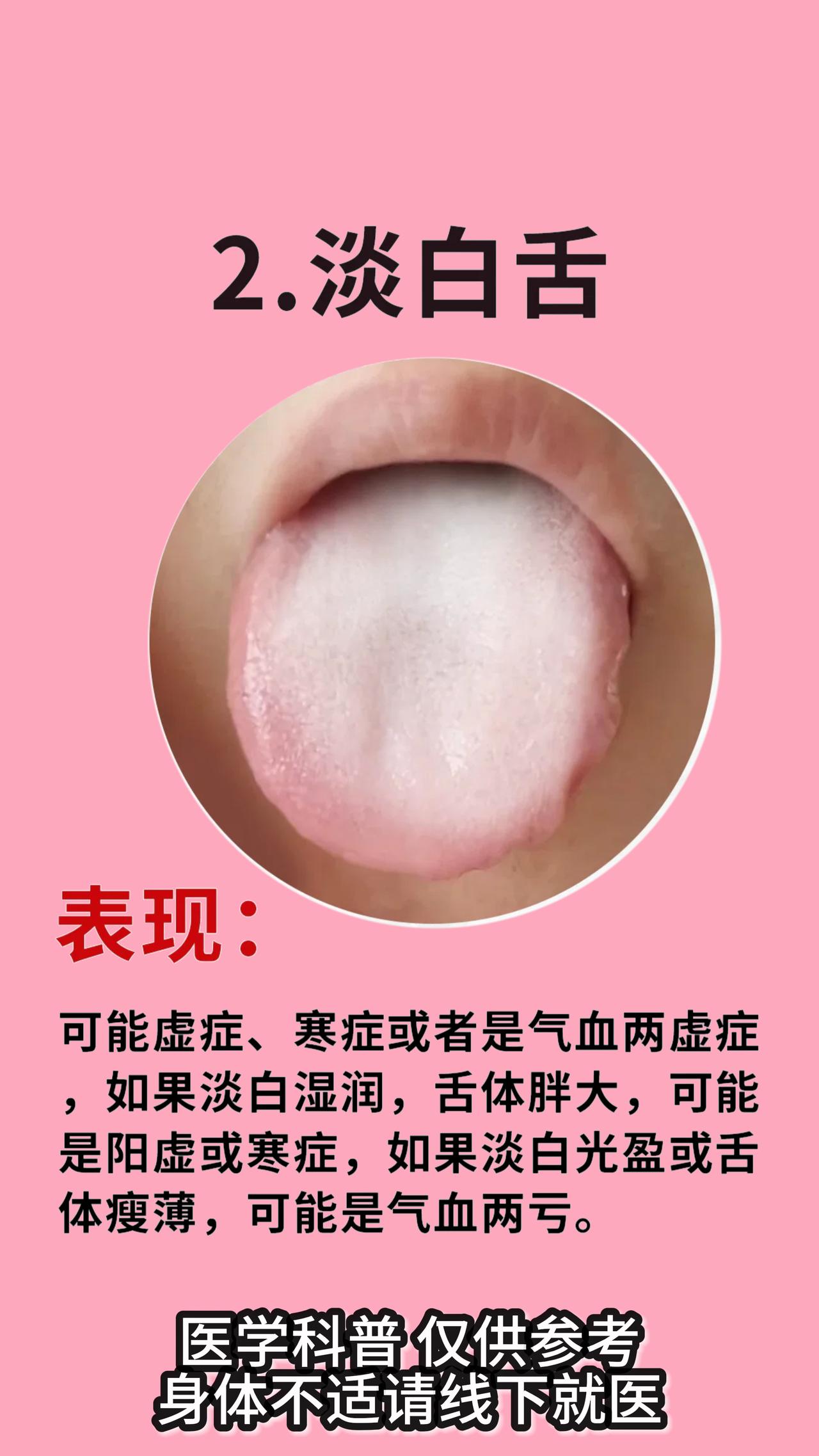 舌象的基本案例 你都了解吗？你的舌头是怎么样的#中医养生##舌头看病早知道#