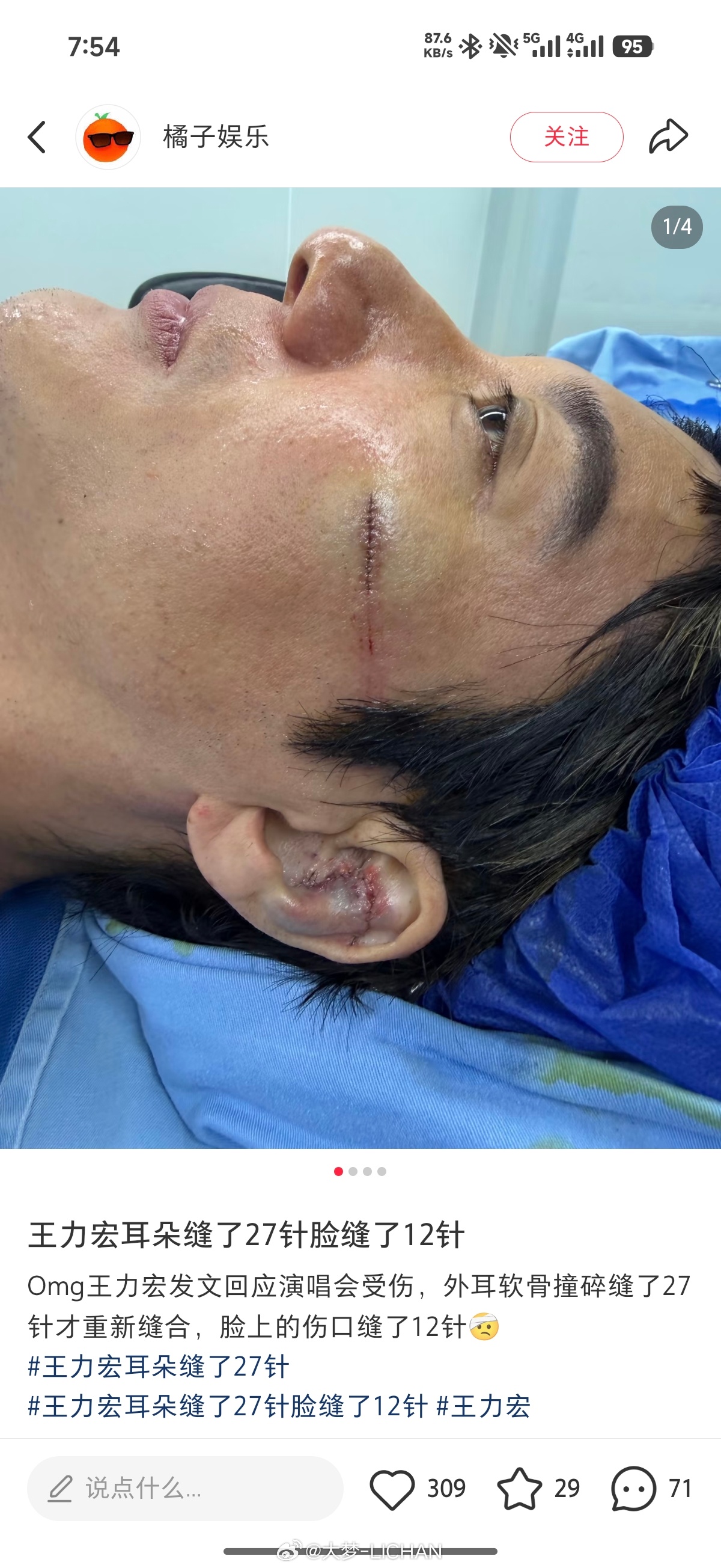 王力宏缝了39针王力宏这个确实有点吓人了，我看了视频真的是结结实实摔了上去，看着