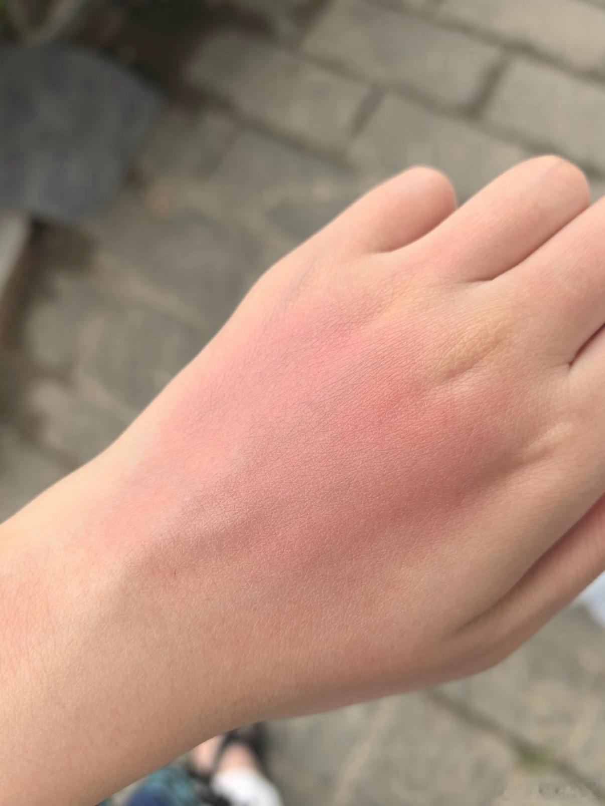 我以前也一直以为只有阳关才会晒黑，结果有一次拍摄被阴天的紫外线背刺了，回家后发现