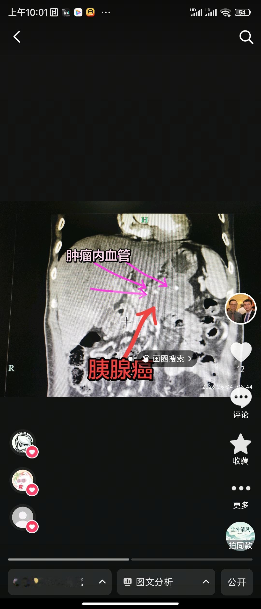 但是，也不能说胰腺癌就无解，现在医学进步，胰腺癌靶向免疫和局部治疗方法越来越多，