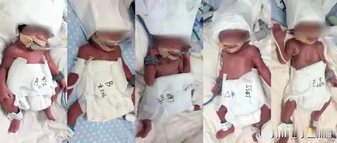 24岁女人，自然受孕，怀孕五胞胎，顺利生产，一男四女，母子平安。
创下了历史奇迹