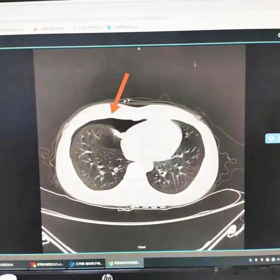 这则新闻描述了一个年轻女孩小刘因在按摩店接受不当针灸治疗而导致气胸的病例。以下是