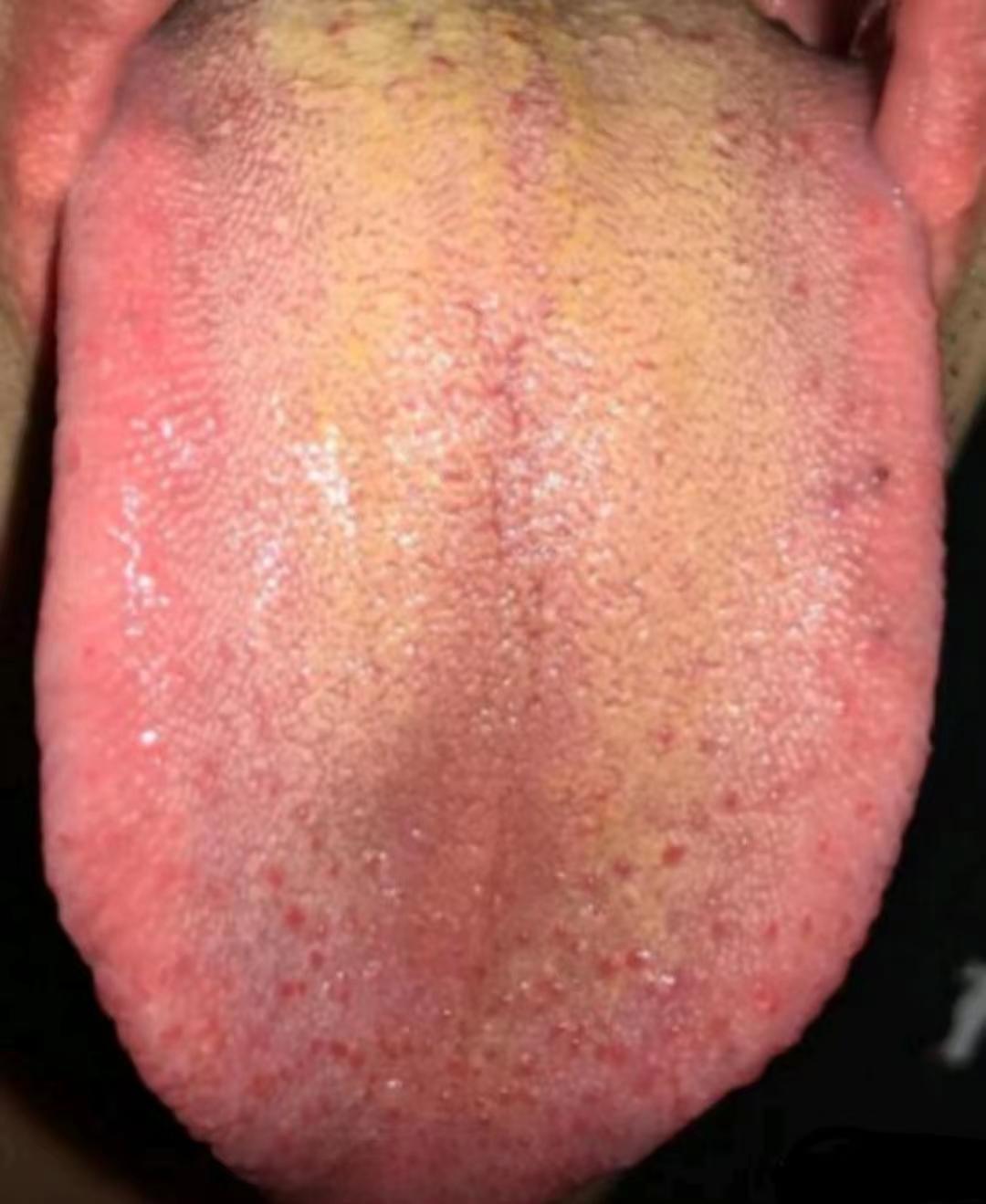 这种舌头，别再补肾了，先去疏肝！
这是个30多岁的病人，正是身强力壮的年纪，但是