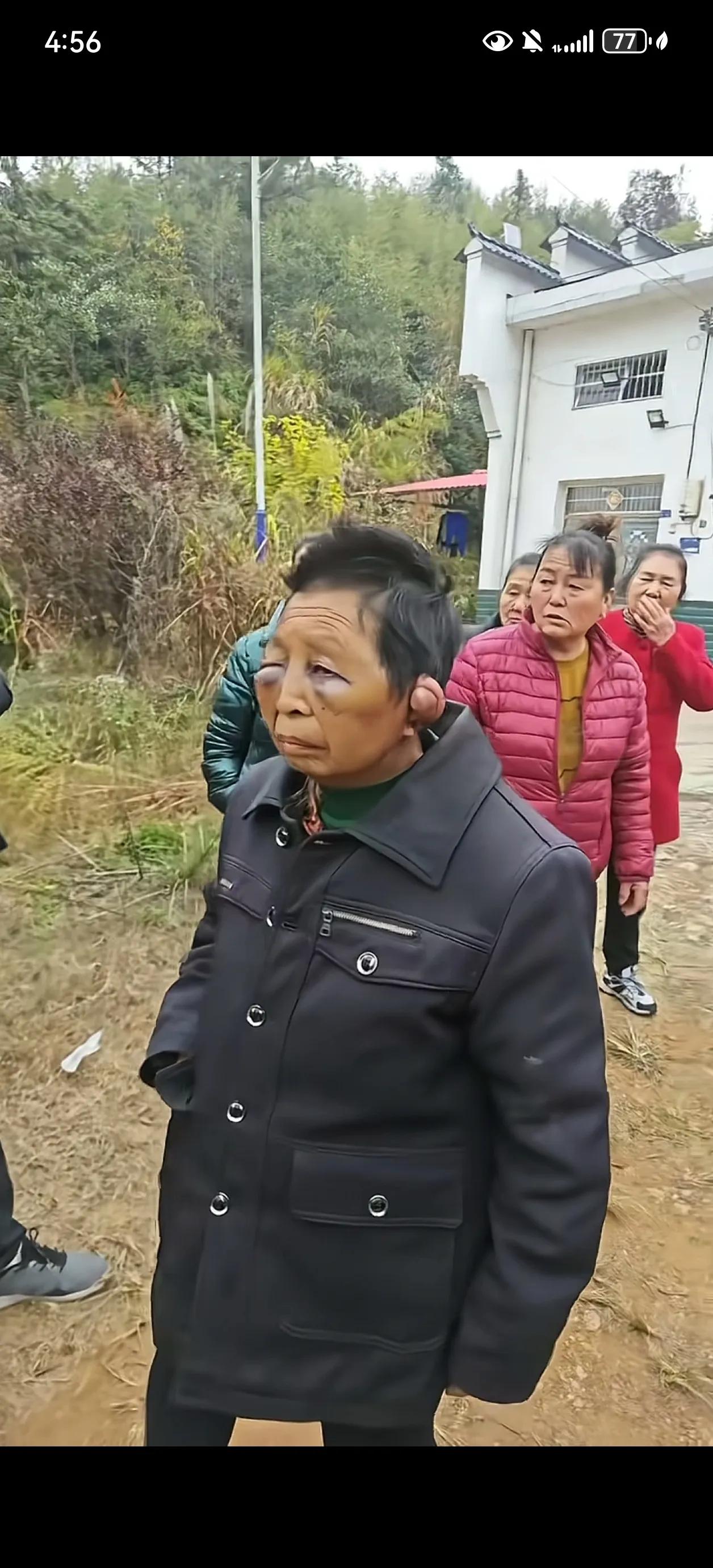 湖南平江那位被家暴的妇女，

   右眼肿成青紫色血泡睁不开，

   脸颊满是