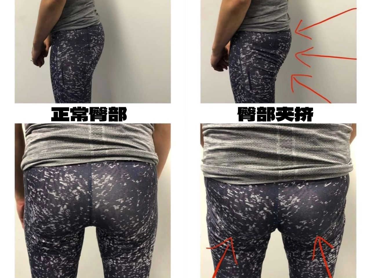 为什么不建议你夹臀？