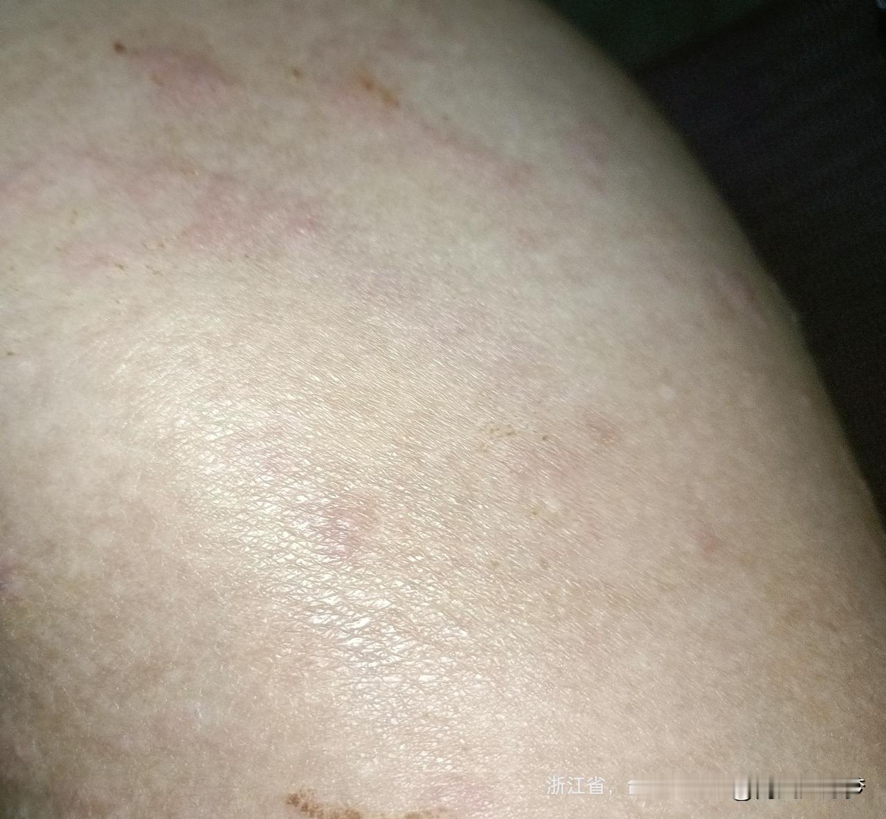 前几天，肚子从胸骨下方到肚脐上方疼，到肚脐疼，再右侧疼，说不出痛还是酸。


昨