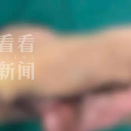 惊险又神奇！男子意外耳朵完全脱落，离体超 20 小时错过黄金时间，医生把断耳 “