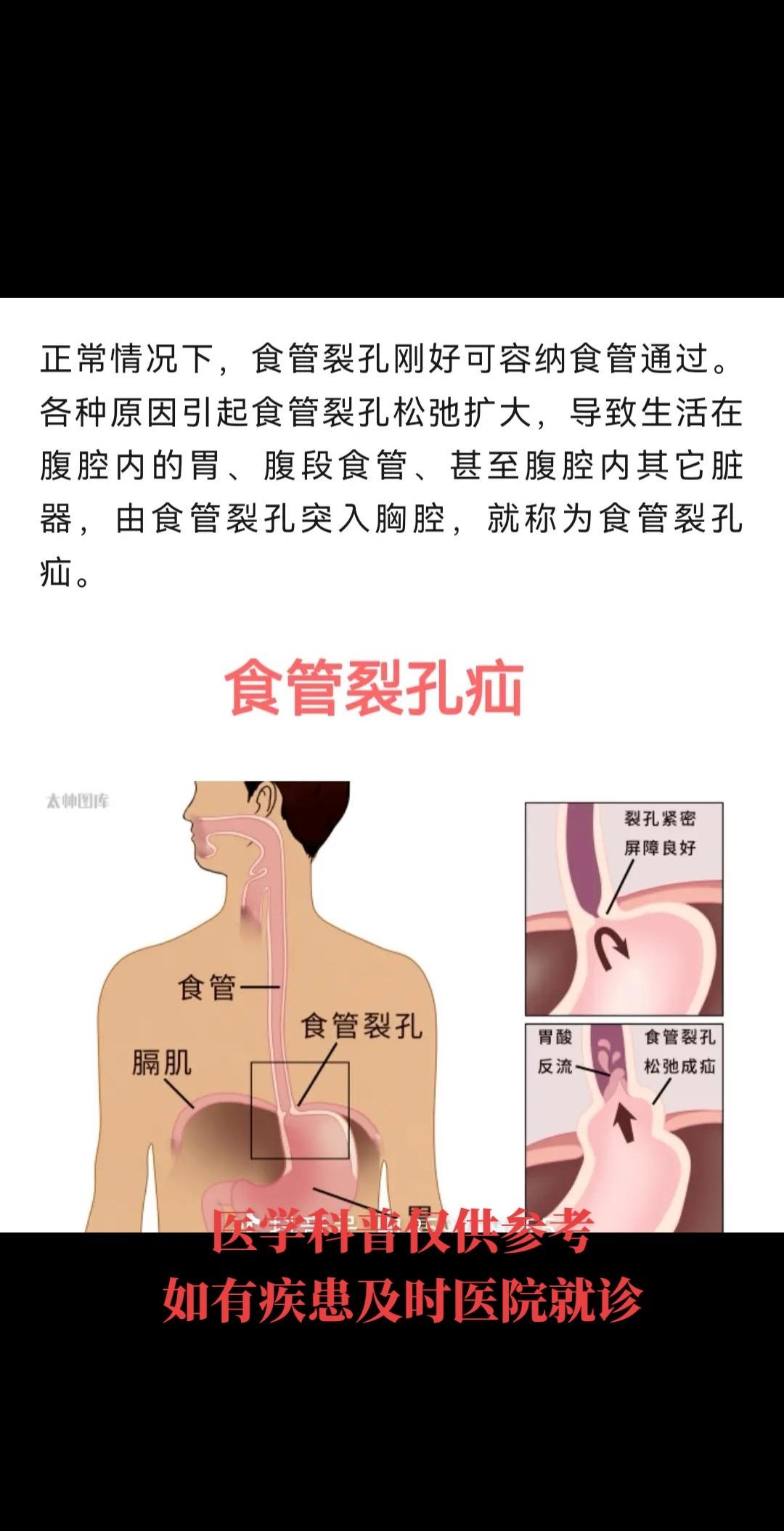 泛酸烧心 四张图片带你了解食管裂孔疝的临床表现，诊断以及外科手术治疗！食管裂孔疝严格意义上应该就诊胸外科！