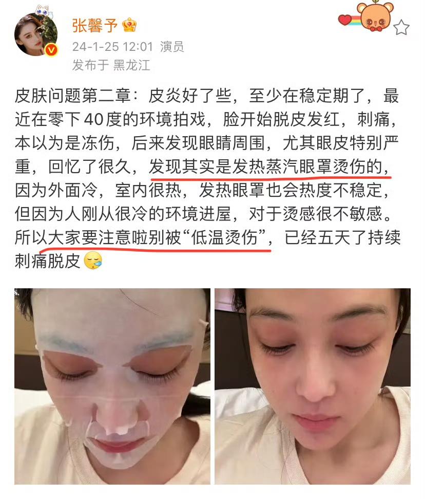 杨幂晒照说自己被蒸汽眼罩烫伤了，张馨予看到以后说自己也被烫伤过，她被烫伤时是冬天