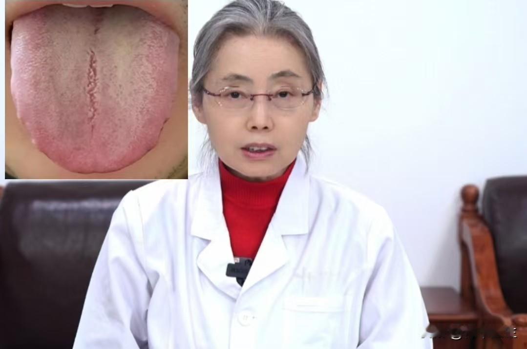 舌中有裂纹，苔黄腻，这种舌象别治错了，病根可不在脾胃！

主诉：时间短，中途易疲