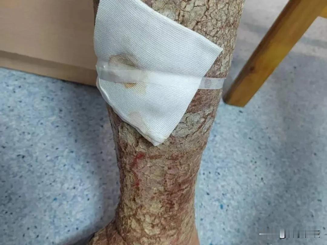 好家伙！腿痒挠挠就没事了？有一位大哥把自己的腿挠成“树皮腿”!

有一大哥觉得腿