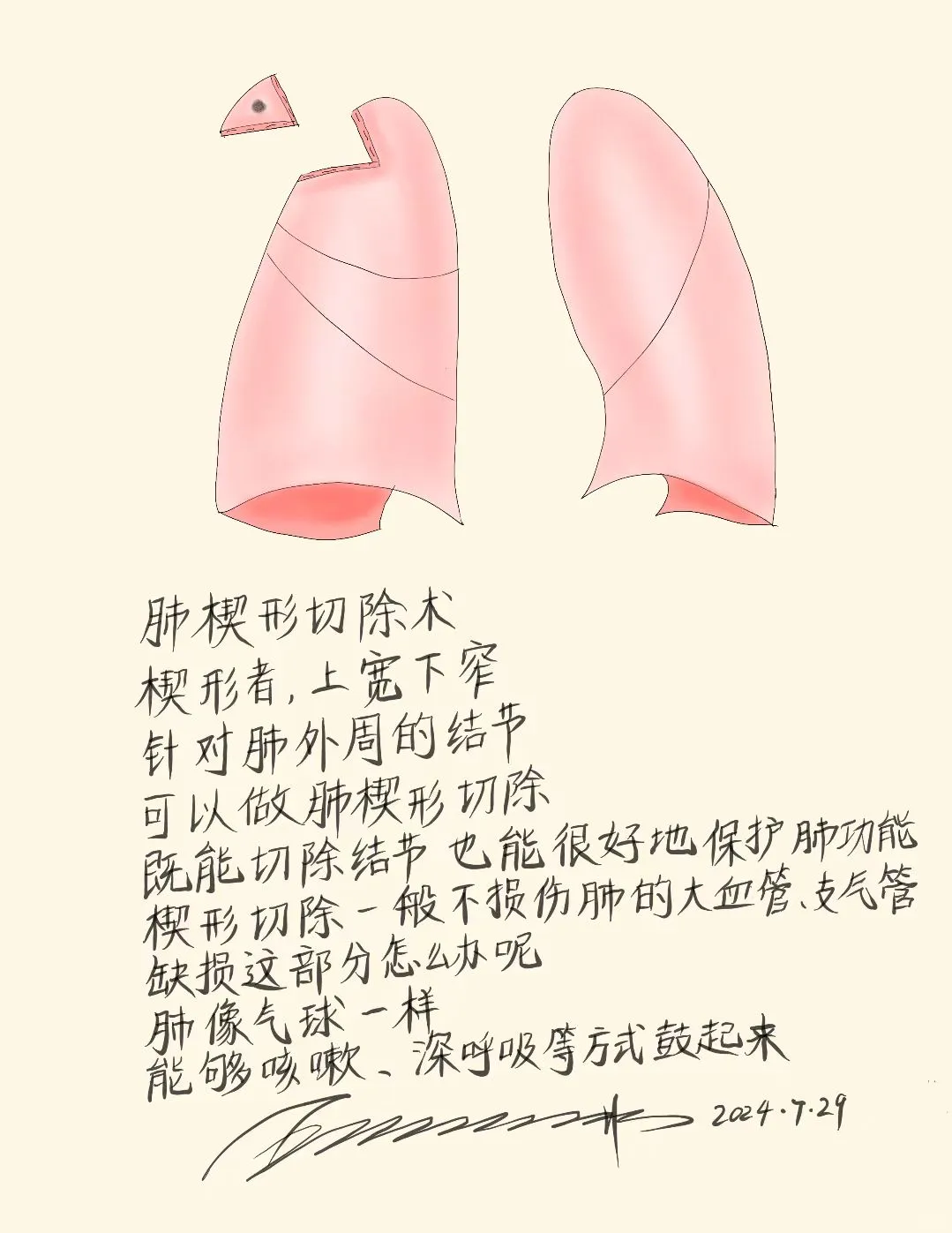 肺楔形切除术