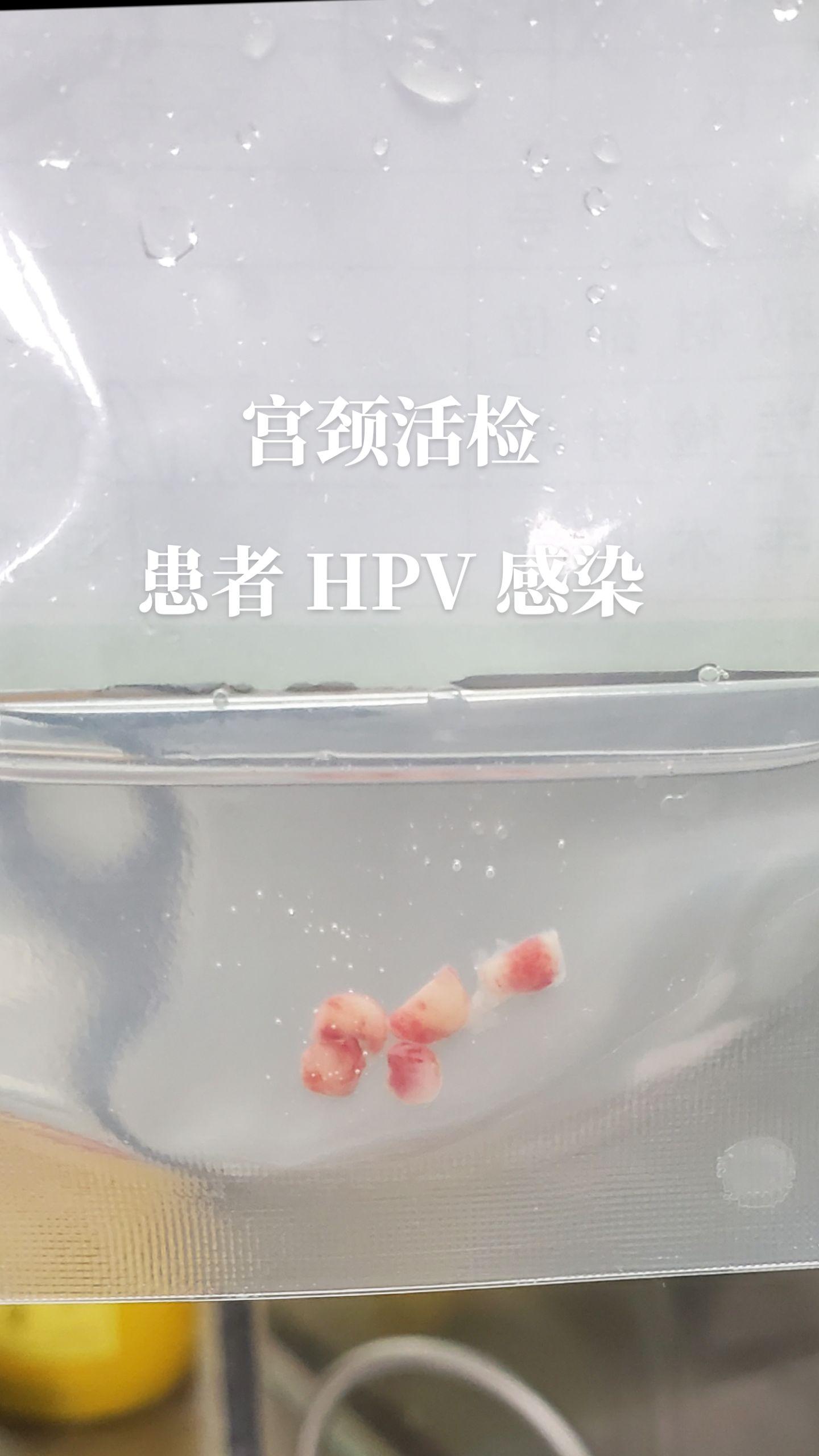 子宫颈活检
hpv感染