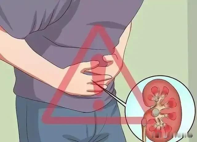 去年7月份，我突然发现了血尿，便查出了13mm的左肾结石，于是到当地县医院做了手