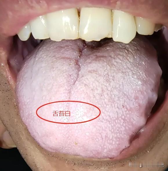 这样的舌头是很怕怕冷的，明显的阳虚畏寒怕冷。
这个舌象一看就是舌体胖大，舌面水滑