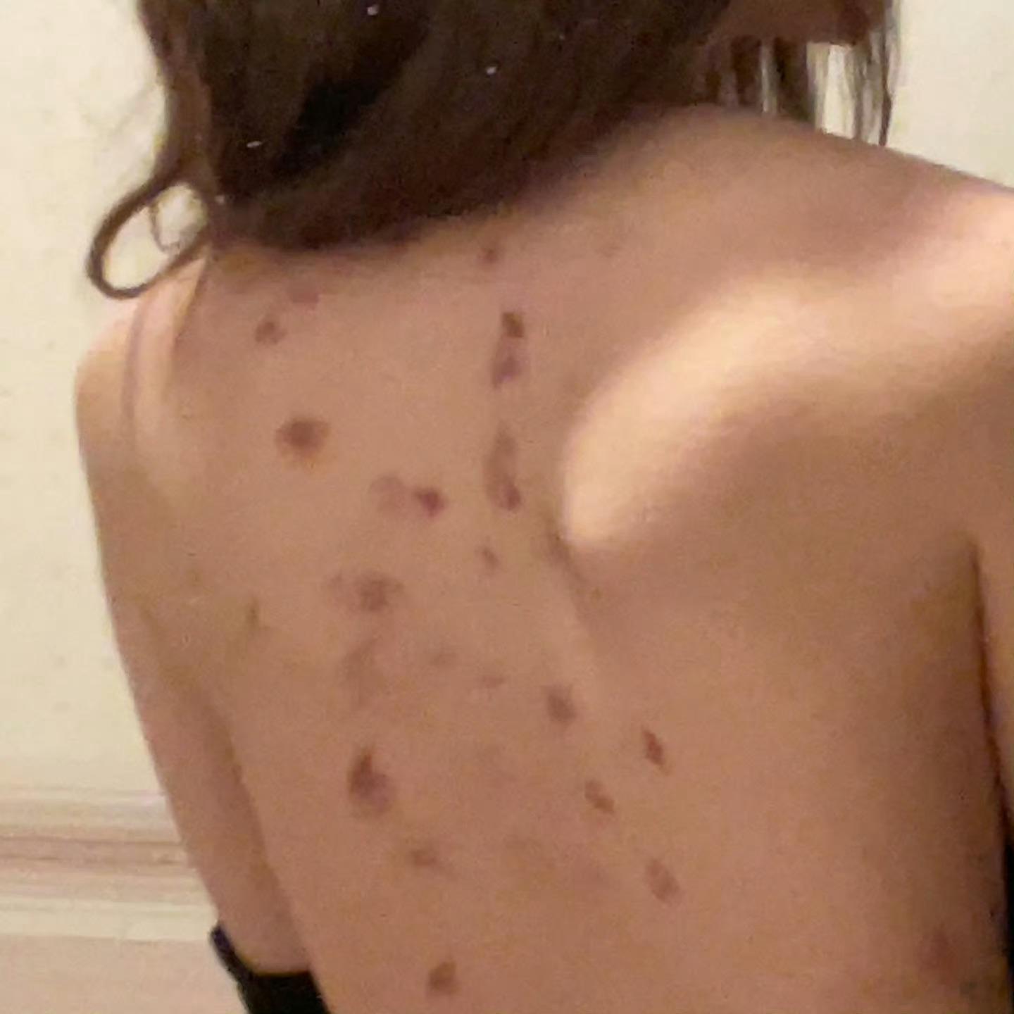 女朋友公司去山区团建，她说这是过敏，是真的吗？  