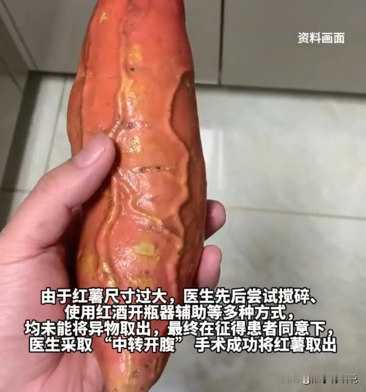 61岁男子塞红薯入肛，剧痛5小时无法取出，医生：再晚点就穿孔了
事情发生在成都。
