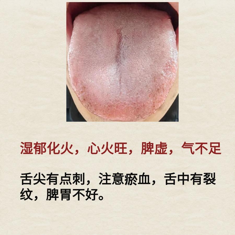舌象案例分析——湿郁化火，肺气虚