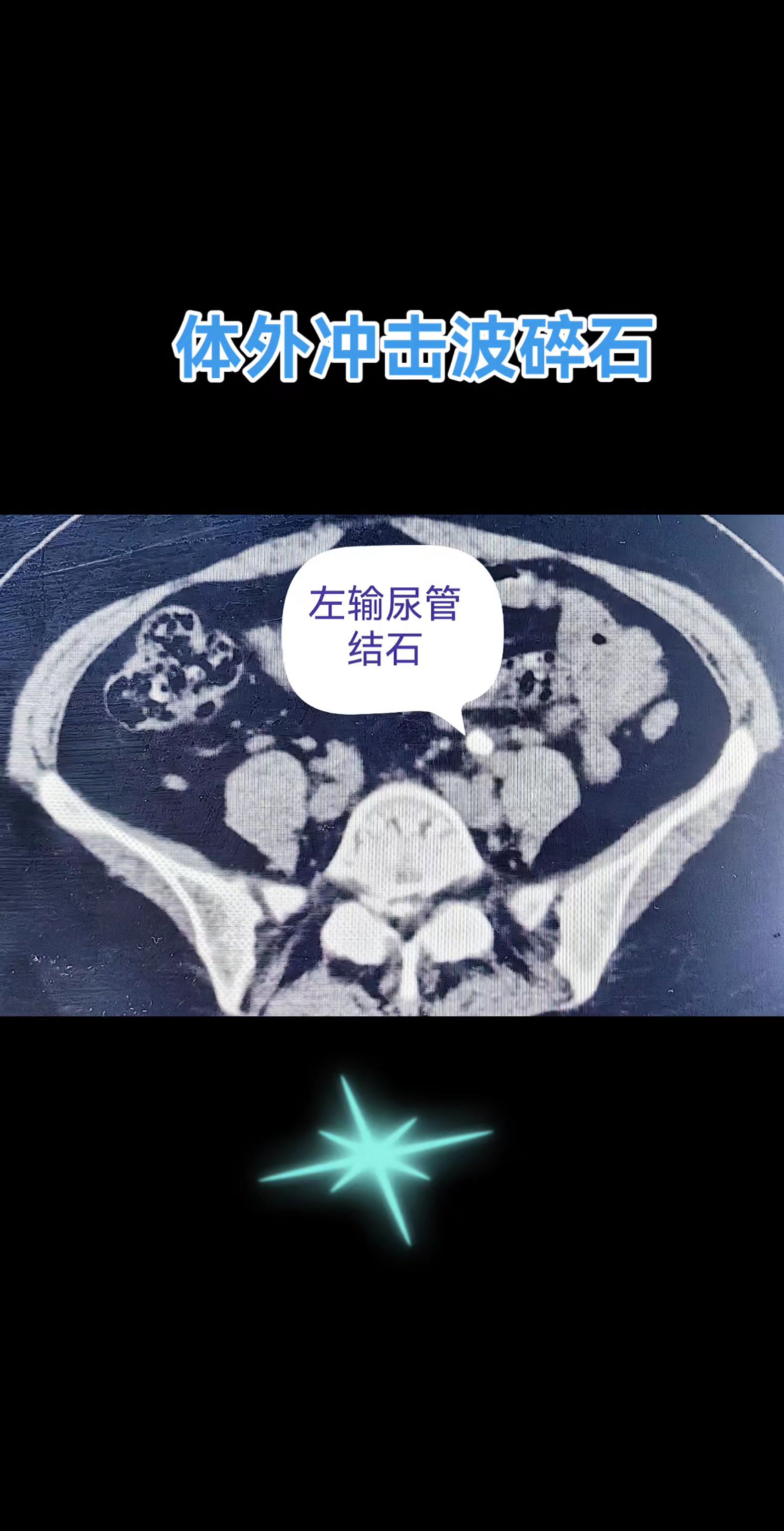 体外碎石